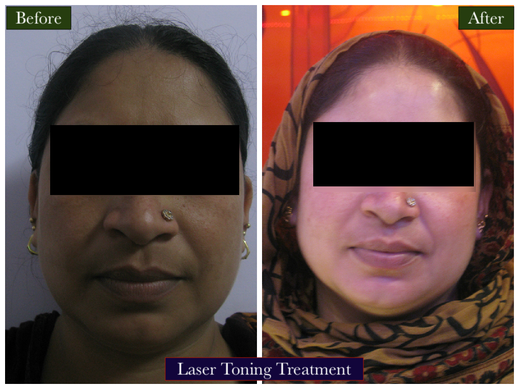 Laser Toning Treatment
